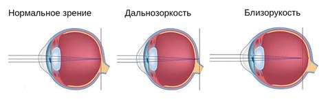 Аккомодация глаза: роль и нарушения