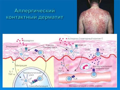 Аллергические реакции и воспалительные процессы