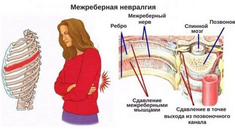 Болевые ощущения при невралгии межреберной области слева