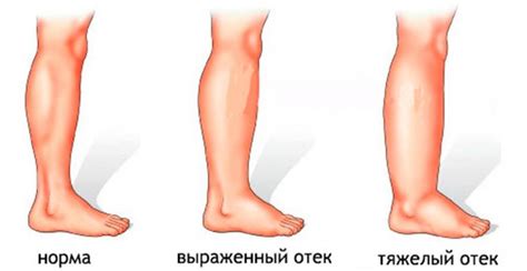 Венозная недостаточность и отеки ног: симптомы и лечение