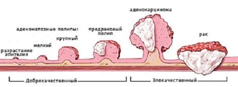 Виды полипов, склонных к кровотечению