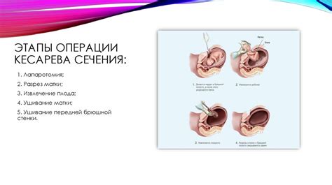 Влияние кесарева сечения на показатели давления