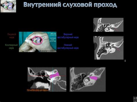 Влияние нарушений микроэкологии внутреннего слухового прохода на образование отложений