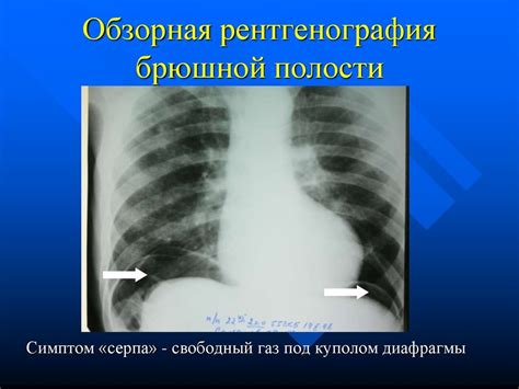 Влияние на организм язвенного дефекта, скрытого под плотным слоем фибрина