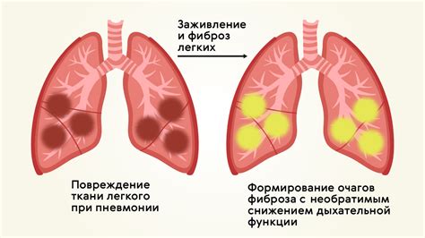 Влияние сатурации на выявление воспаления легких