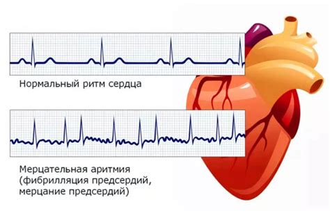 Влияние стресса на предсердный ритм