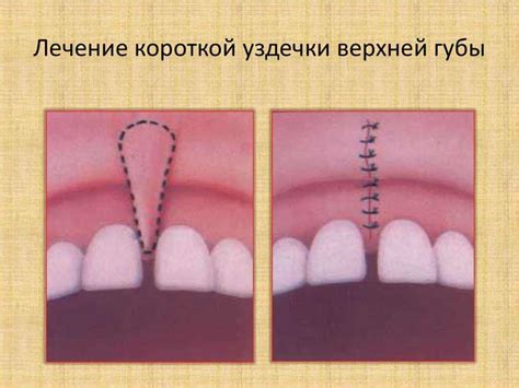 Влияние травматического воздействия на процесс заживления у уздечки