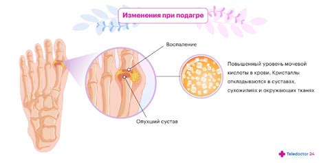 Вода и осложнения подагры