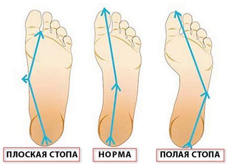 Возможности развития физической активности при плоскостопии