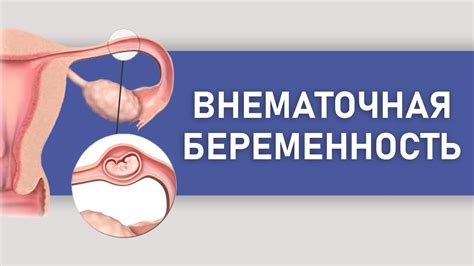 Возможность несоответствия диагностики при внематочной беременности