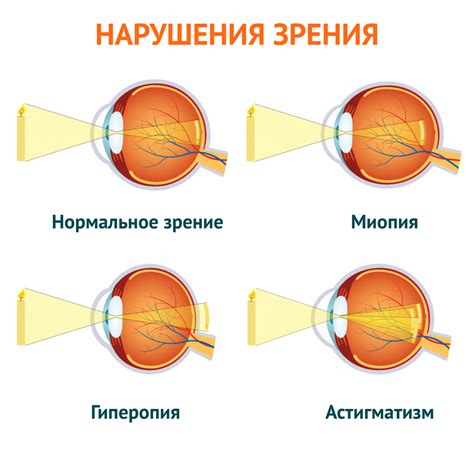 Возможные причины нарушения аккомодации глаза у взрослых