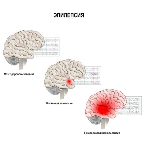 Генерализованная эпилепсия: описание и причины