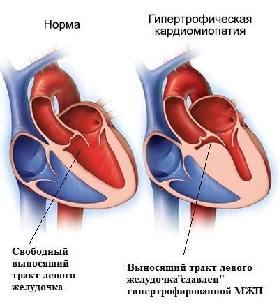 Гипертрофия левого желудочка: диагностика и причины