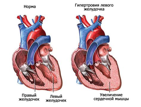 Гипертрофия левого желудочка: питание и образ жизни