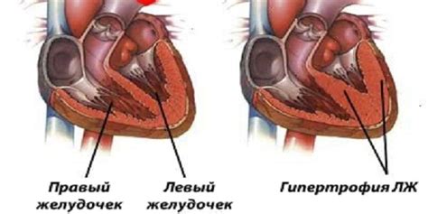 Гипертрофия левого желудочка: профилактика и лечение