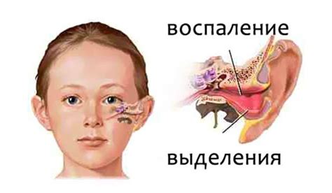 Гнойный отит: симптомы и причины возникновения