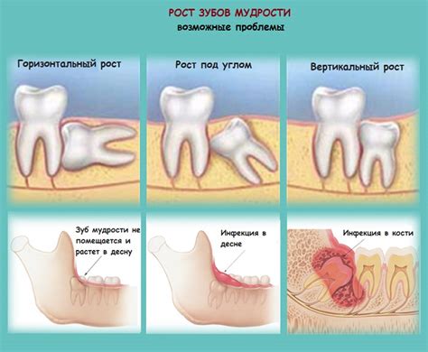 Деструкция зубов и десен