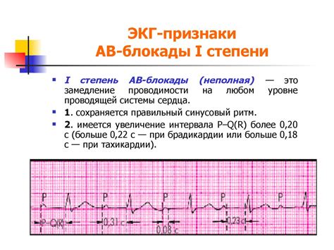 Диагностика блокады 2 типа