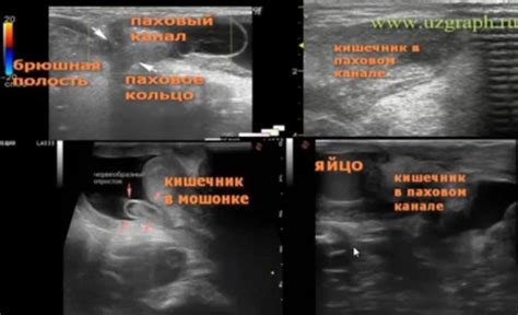 Диагностика грыжи и методы лечения