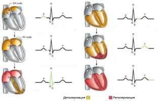 Диагностика и лечение нарушений реполяризации миокарда на ЭКГ