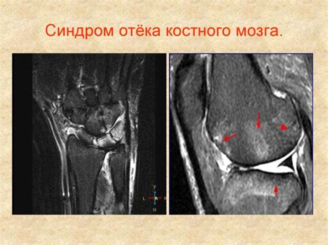 Диагностика и обследование при подозрении на воспаление костного мозга коленного сустава