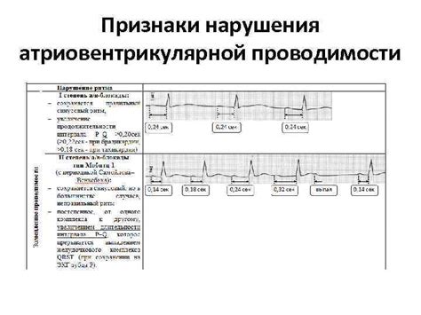 Диагностика нарушения атриовентрикулярной проводимости