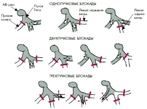 Диагностика нарушения внутрижелудочковой проходимости