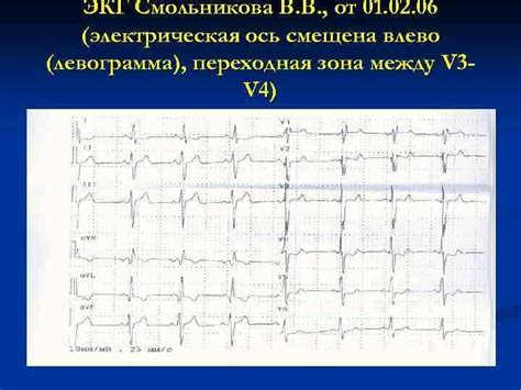 Диагностика сердечных проблем: как помогает ЭКГ