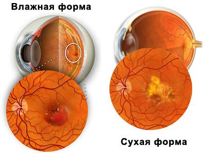 Диагностика сухой макулодистрофии