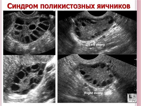 Диагностика фолликулов в яичниках