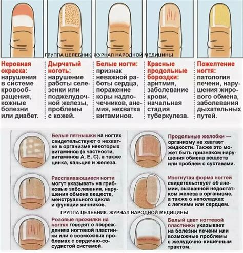 Диагностика чернения ногтей