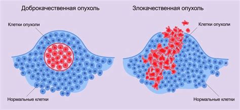 Доброкачественная опухоль