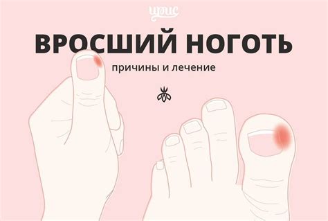 Домашние методы лечения загибания ногтя