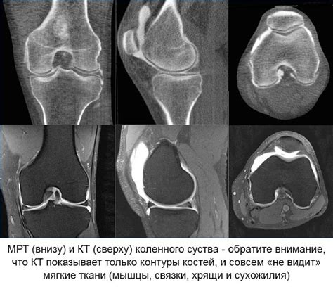 Значимость регулярного использования льда в случае повреждения сустава в области колена