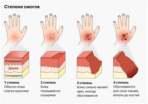 Избегание ожогов при использовании воскоплава