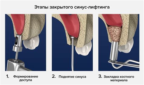 Как влияет на процедуру синус-лифтинга на организм при наличии простуды