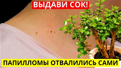 Как избавиться от папиллом