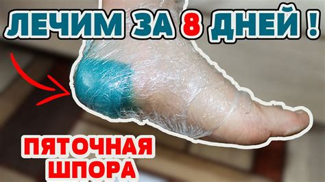 Как избавиться от шпор на подошве