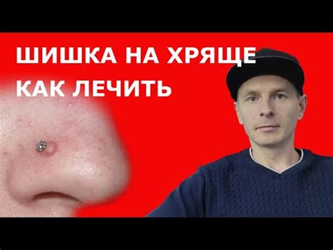 Как лечить шишку между грудями