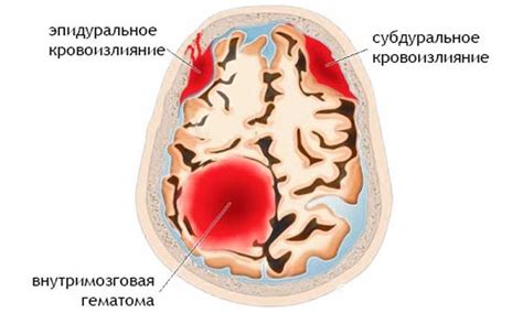 Как предупредить кровоизлияние в мозг у новорожденных