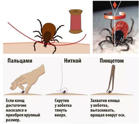 Как убрать головку клеща у ребенка без проблем