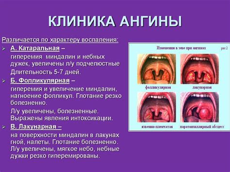 Когда нужно обратиться к врачу по поводу гнойников на миндалинах