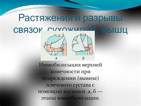 Консервативное управление при повреждении связок верхней конечности