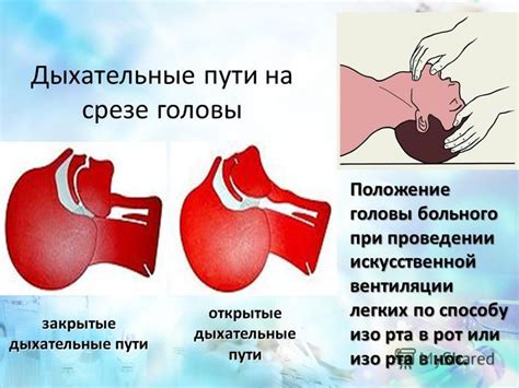 Корректная позиция головы при проведении искусственной вентиляции легких: полезные рекомендации