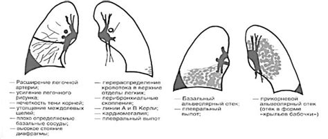 Краткое резюме: роль рентгенографии в комплексном подходе к лечению бронхиальной астмы