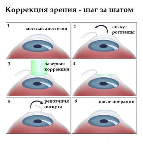 Лазерная коррекция зрения: эффективный метод