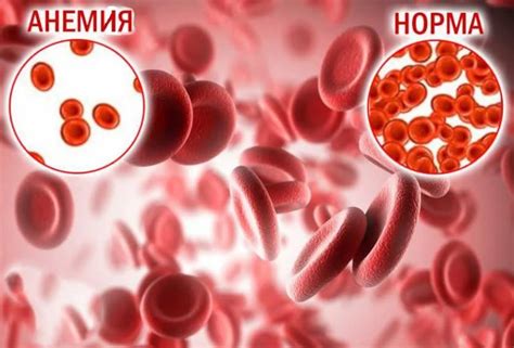 Лечение анемии и нормализация гемоглобина