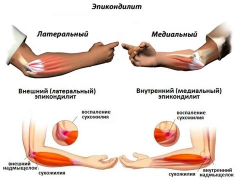 Лечение наружного эпикондилита локтевого сустава