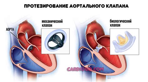 Лечение нарушения процесса реполяризации левого желудочка