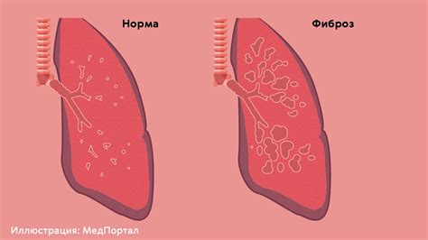 Лечение хрипов в нижних отделах легких